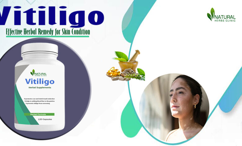 Natural Cures For Vitiligo