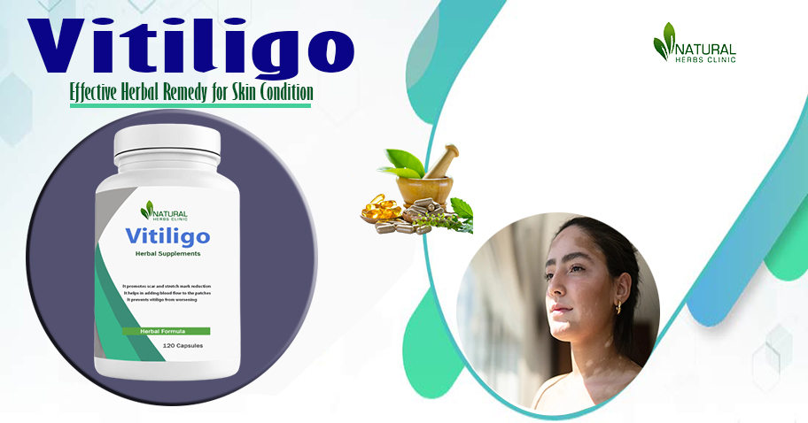 Natural Cures For Vitiligo