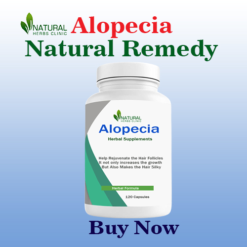 Alopecia Natural Treatments