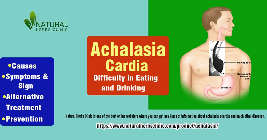 Achalasia Cardia Definition: The Enigmatic Esophageal Disorder img