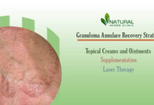 Granuloma Annulare Recovery Strategies