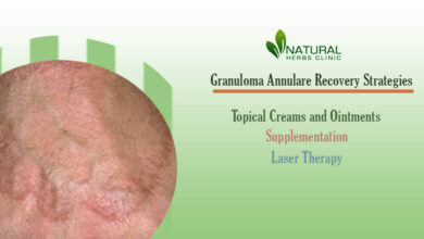 Granuloma Annulare Recovery Strategies