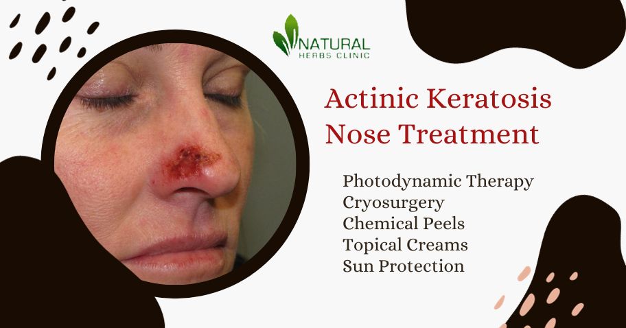 Actinic Keratosis Nose Treatment
