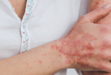 Long Term Use of Quinacrine Drugs