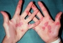 Rash in Mucous Membranes