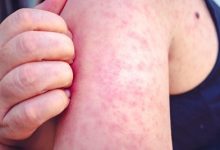 Yellowish or skin-colored to red