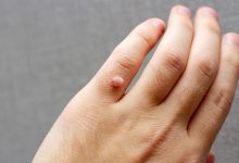 Fixed lumps on the skin in subcutaneous GA