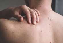 Lesions May Be Present for Years