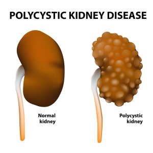 polycystic-kidney-disease-natural-treatment-at-home 