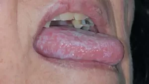 Oral Lichen Planus