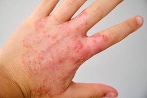 eczema