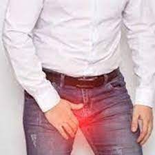How To Cure Hydrocele Naturally 1