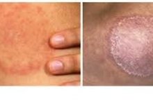 Granuloma-Annulare-vs-Ringworm-A-Simple-Guide-to-Avoid-Misdiagnosis
