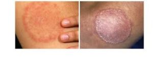 Granuloma Annulare vs Ringworm: A Simple Guide to Avoid Misdiagnosis