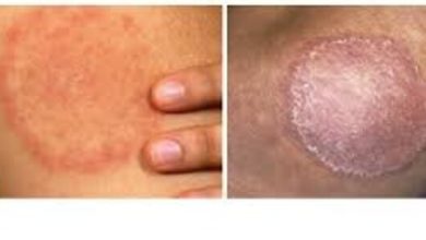 Granuloma-Annulare-vs-Ringworm-A-Simple-Guide-to-Avoid-Misdiagnosis
