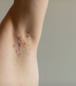 the-science-behind-essential-oils-for-hidradenitis-suppurativa-relief