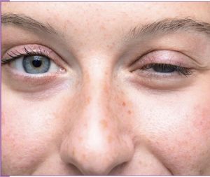 magnesium-and-myasthenia-gravis-could-this-mineral-hold-the-key-to-relief