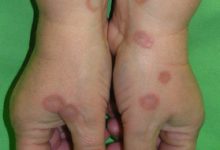 granuloma-annulare-in-children-causes-myths-and-natural-care-tips