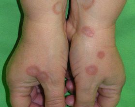 granuloma-annulare-in-children-causes-myths-and-natural-care-tips