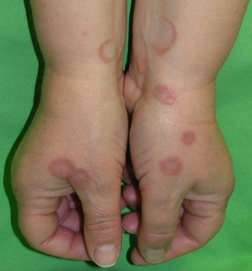 granuloma-annulare-in-children-causes-myths-and-natural-care-tips