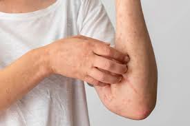 polycythemia-vera