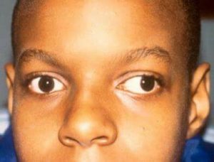myasthenia-gravis-in-children-10-signs-parents-should-never-ignore