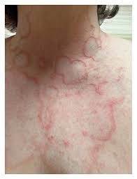 what-is-granuloma-annulare