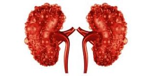 the-ultimate-polycystic-kidney-disease-diet-what-to-eat-&-what-to-avoid